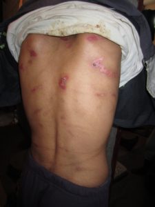 151447_Detainee_in_Misratah_shows_Amnesty_International_scars_of_wounds_medium
