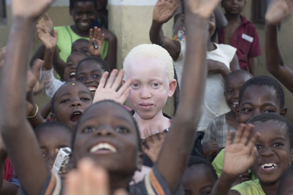 Albinism campaign - Annie